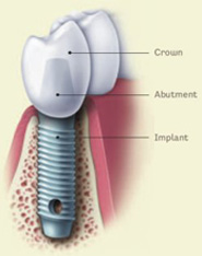 Implants Image 3