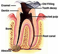 Root Canals Image 2