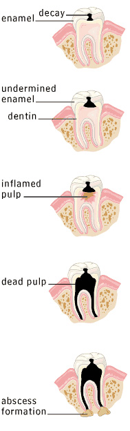 Root Canals Image 3