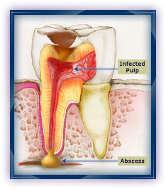 Tooth Decay Image 1